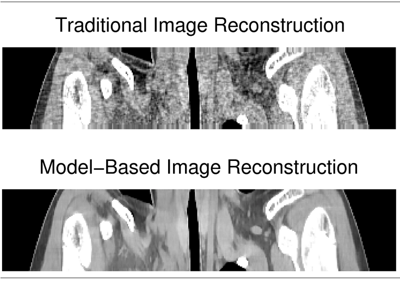 For a summary of how model-based image reconstruction methods lead to improved image quality and/or lower X-ray doses, see: http://web.eecs.umich.edu/~fessler/re